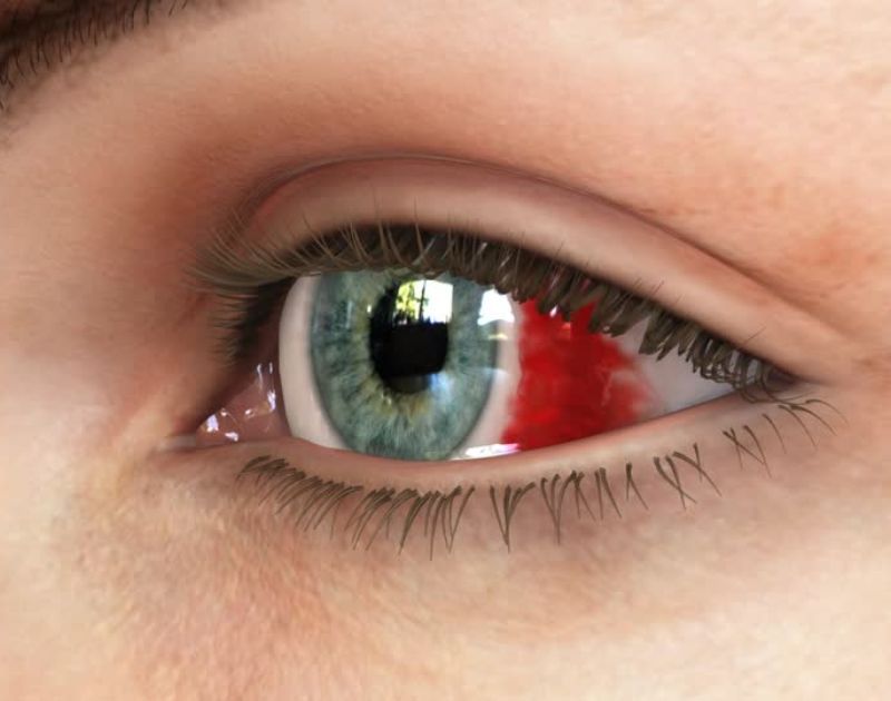 Blood in the Eye