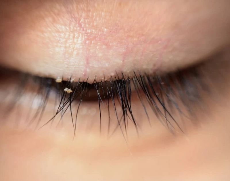 Crusty Eyelid
