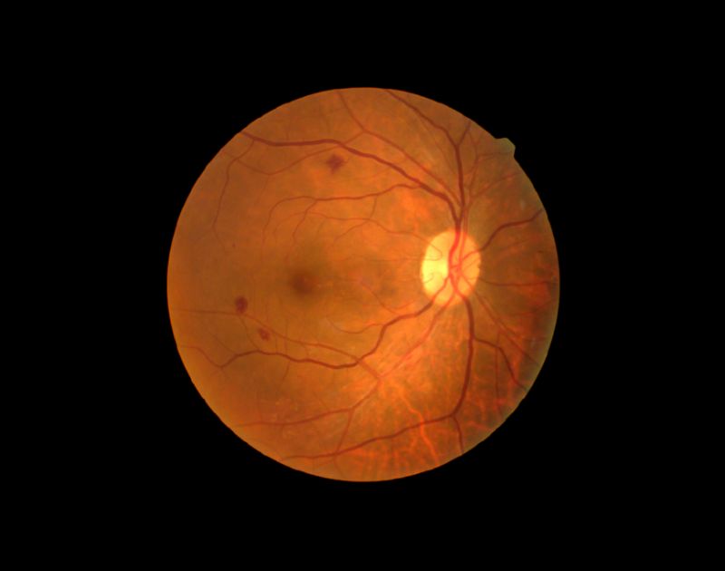 Diabetic Retinopathy