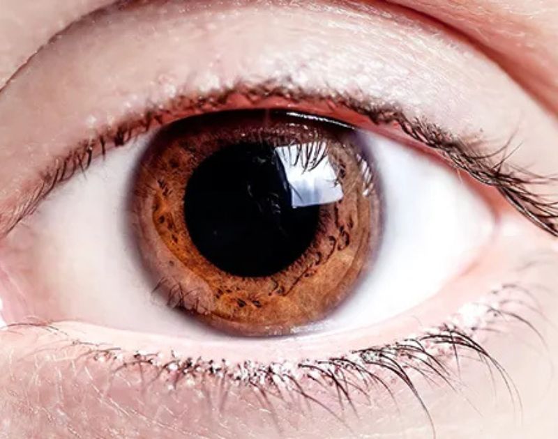 dilated