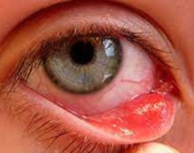 Ectropion