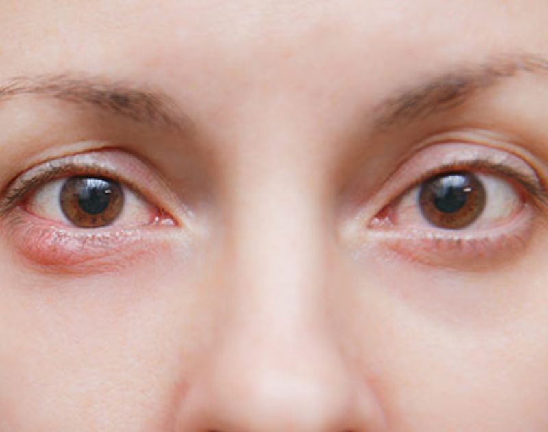 Eye Inflammation