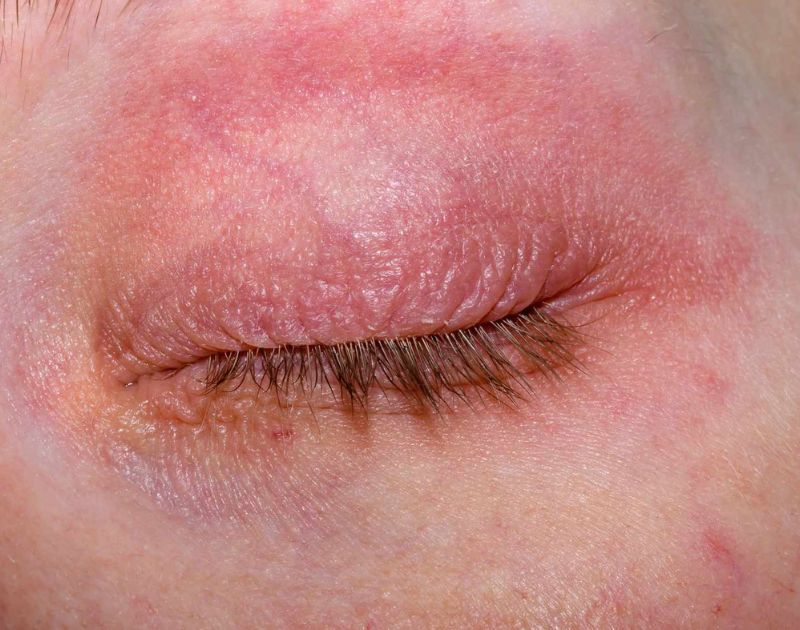 Eyelid Redness and Rash