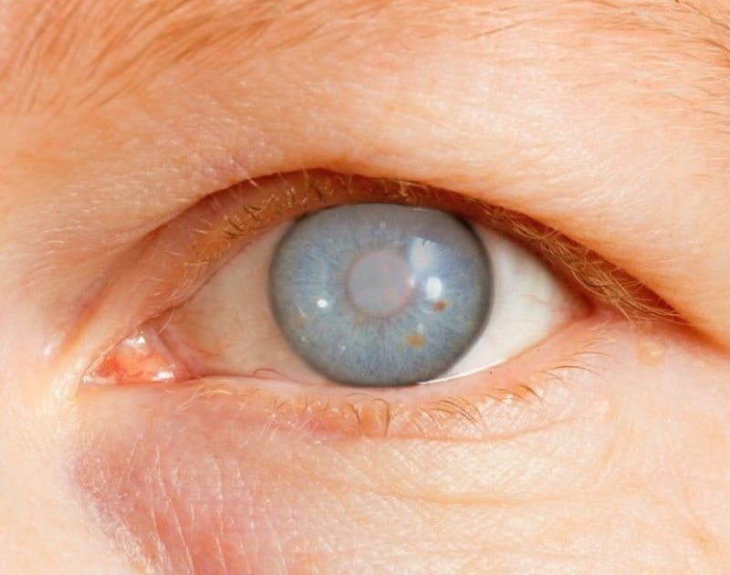 Glaucoma Treatment (1)