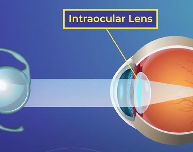 Intraocular Implants (IOLs)
