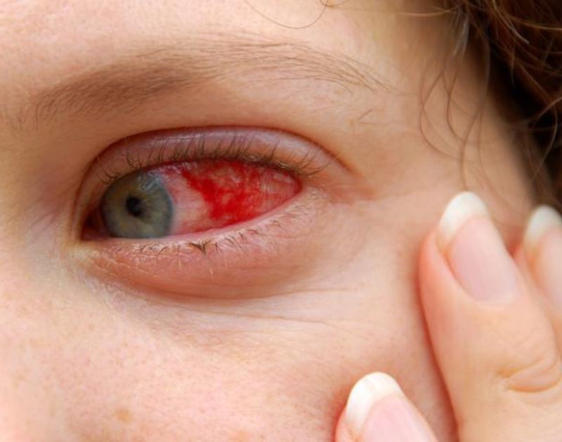 Red Eye